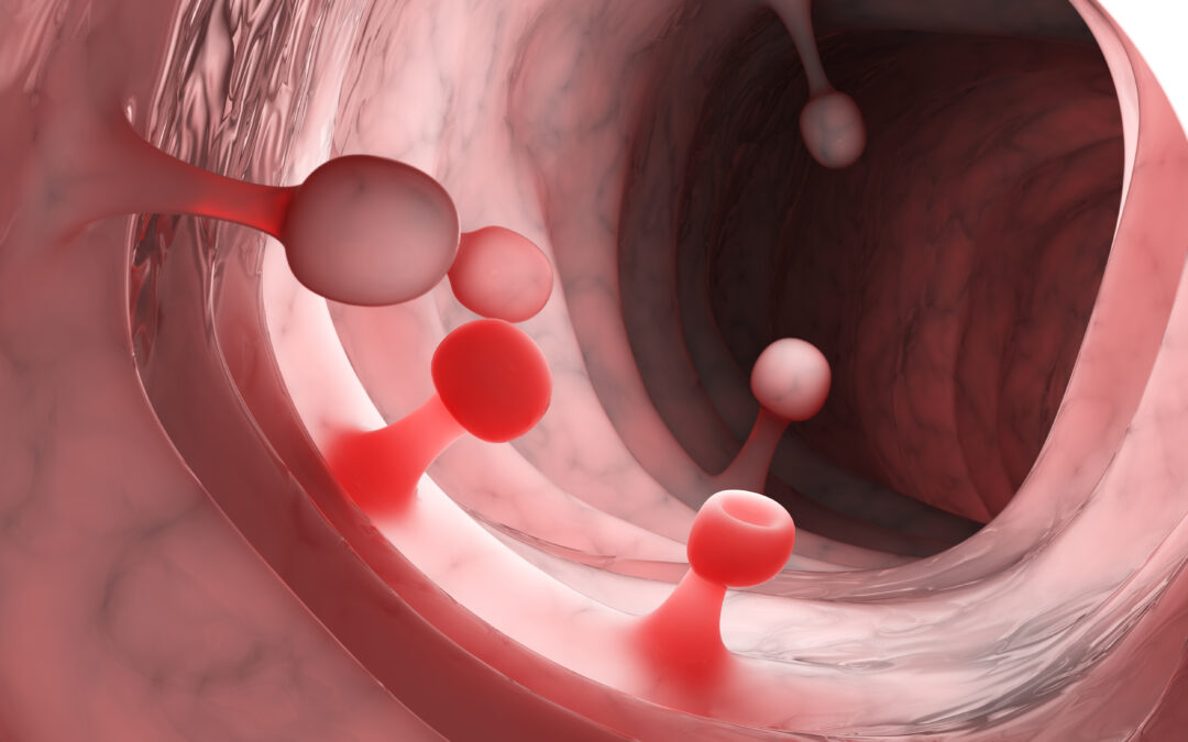 Prescient Medicine and Metabiomics Partner to Develop New Gastrointestinal Health Tests to Detect Polyps, Prevent Colon Cancer